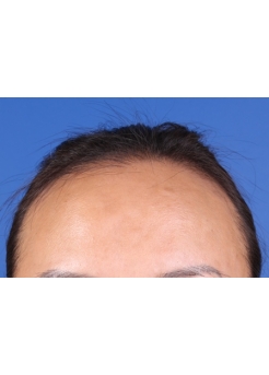 Before Hair Transplant&nbsp;Hairline
